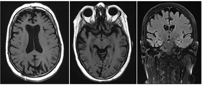 The Use of Biomarkers and Genetic Screening to Diagnose Frontotemporal Dementia: Evidence and Clinical Implications